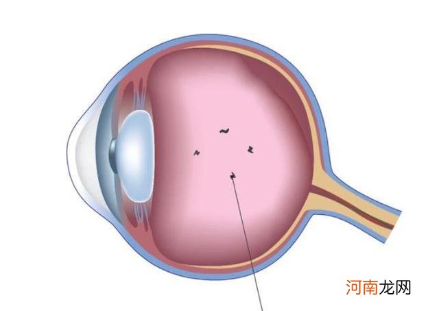 飞蚊症怎么治 治疗眼睛飞蚊症