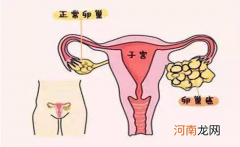 附件囊肿是怎么形成的 附件囊肿是怎么形成的,如何治疗月经一直不干净