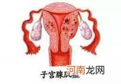 子宫腺肌症怎么治疗 轻度子宫腺肌症怎么治疗