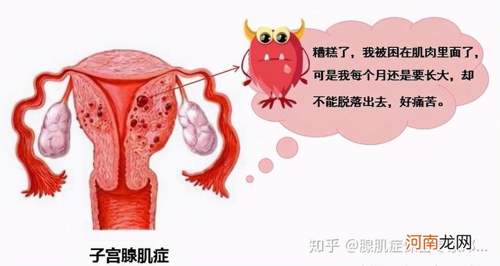 子宫腺肌症怎么治疗 轻度子宫腺肌症怎么治疗