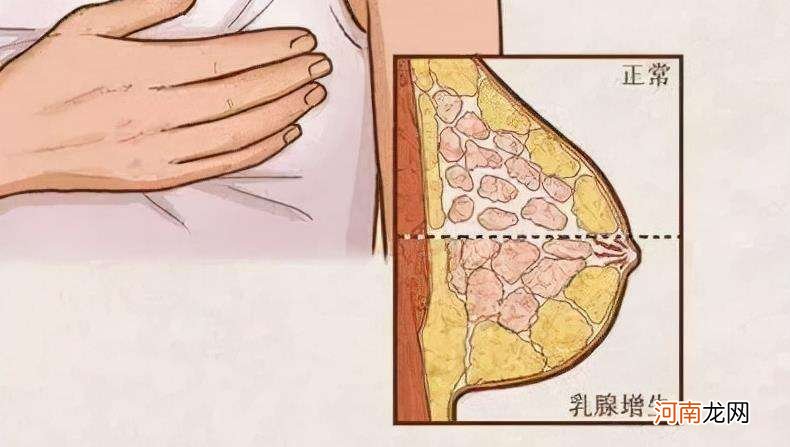 乳腺增生怎么办 乳腺增生是怎么回事严重吗