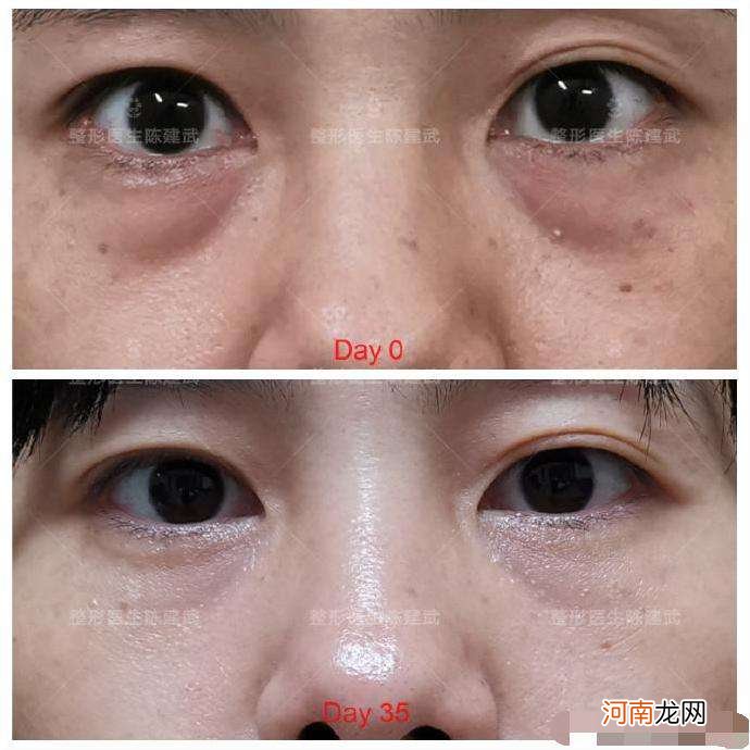 黑眼圈很重怎么办 小孩黑眼圈很重怎么办