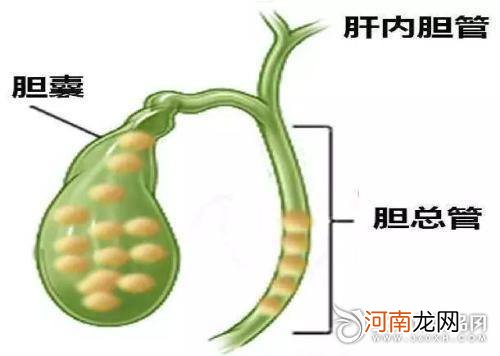 胆结石怎么消除 泥沙状胆结石最佳治疗方法胆结石怎么消除