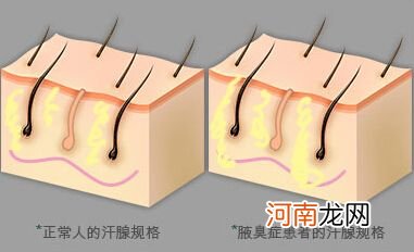 狐臭怎么治疗最有效的方法 18岁狐臭怎么治疗最有效的方法