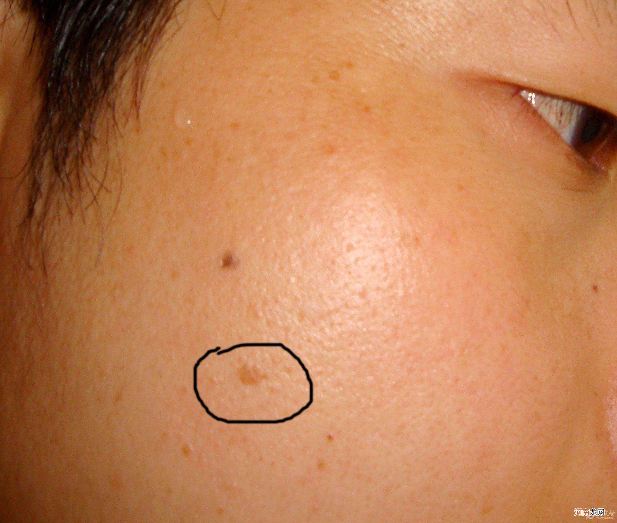 扁平疣怎么去除 脸上长的扁平疣怎么能给它除掉