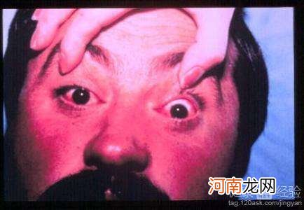 眼眶疼是怎么回事 右侧眼眶疼是怎么回事