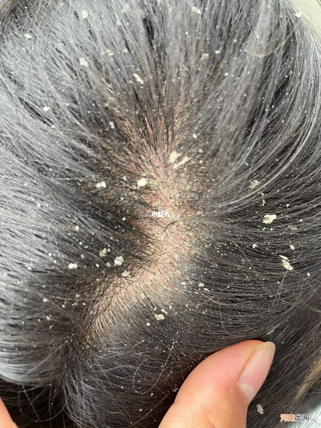 头皮屑多怎么治疗 真菌感染头痒头皮屑多怎么治疗