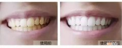 牙黄怎么快速变白 牙黄怎么快速变白 知乎