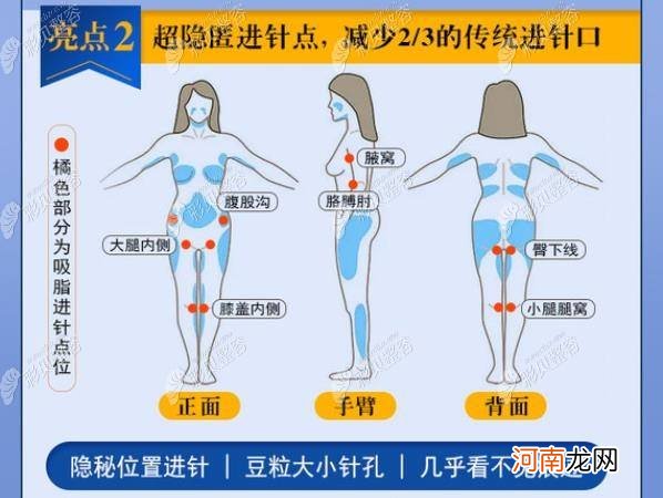 抽脂哪里好 哪里抽脂比较好啊