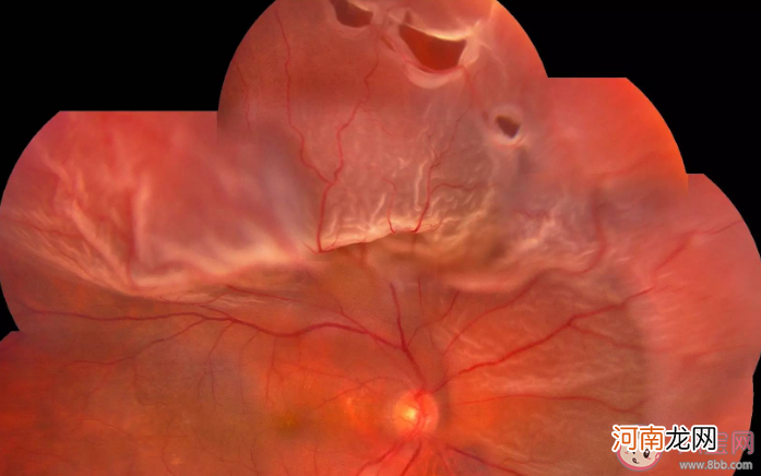 考研女生|考研女生用眼过度视网膜裂孔 视网膜裂孔有什么症状