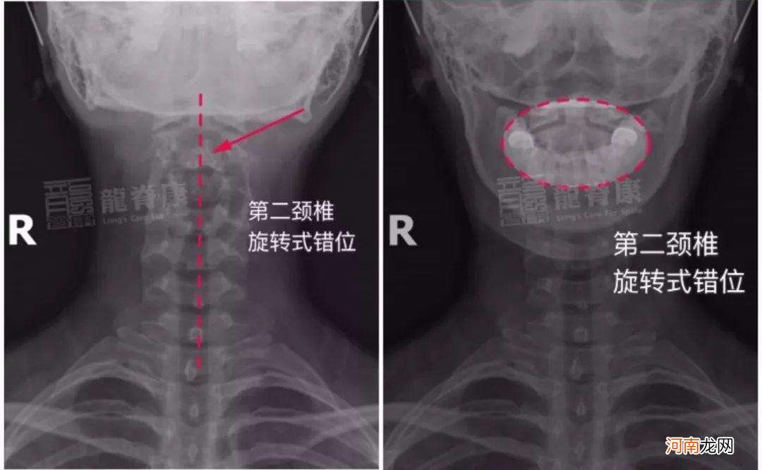 哪里是颈椎 哪里是颈椎疼