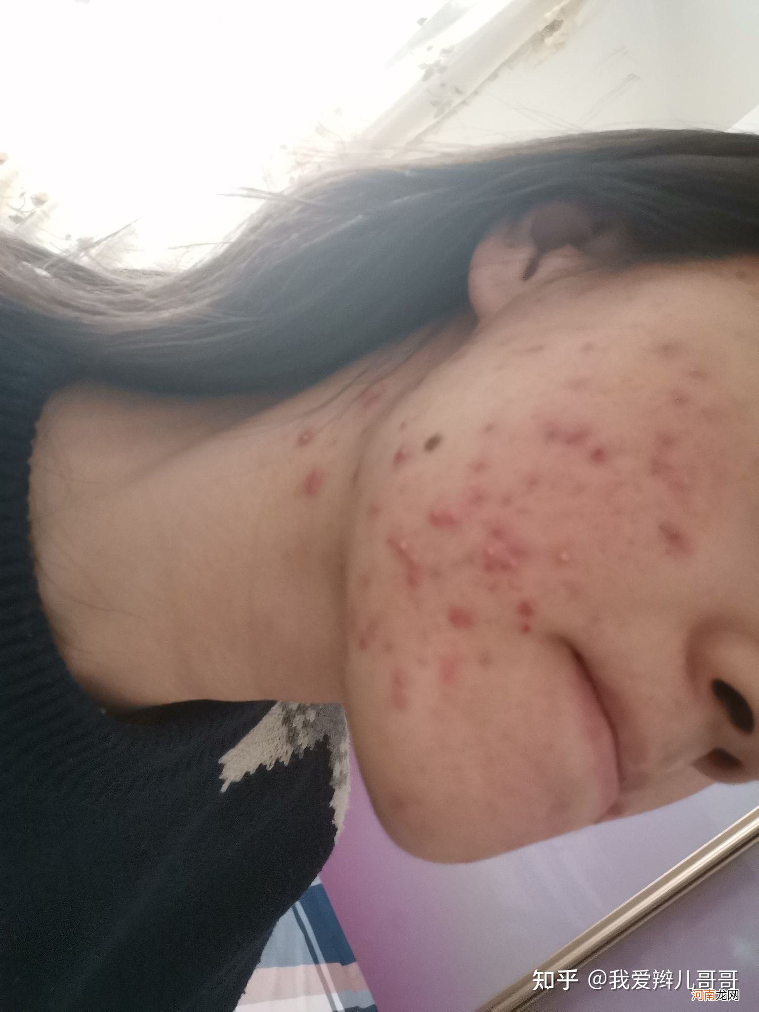 怎样消痘 怎样消痘快