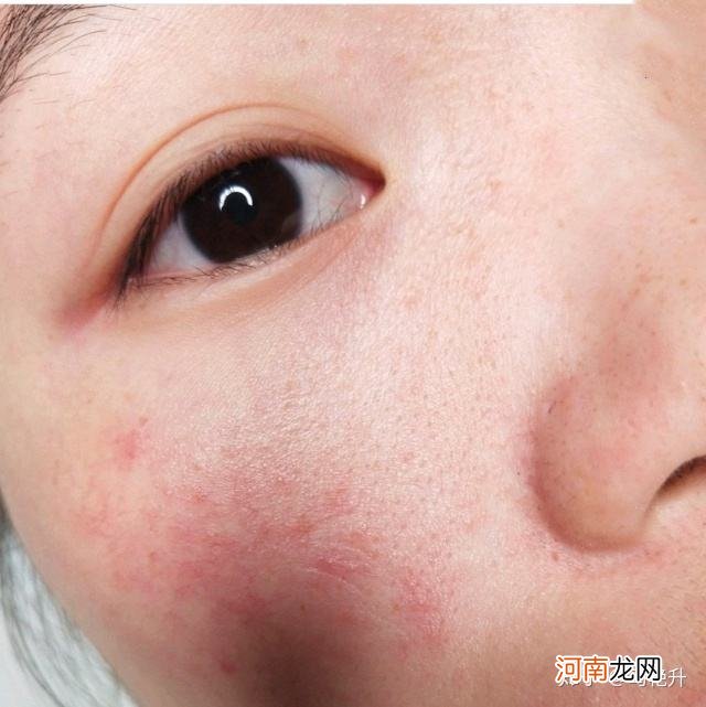 怎样去除红血丝 怎样去除红血丝药膏