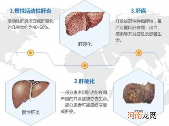 得了肝硬化还可以活多久？ 肝硬化会死吗