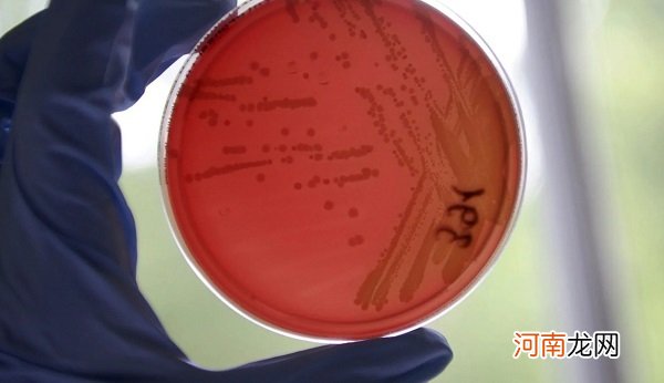 埃菲社：肠癌治疗后复发和转移元凶被科学家揪出 致病细胞作怪有办法遏制