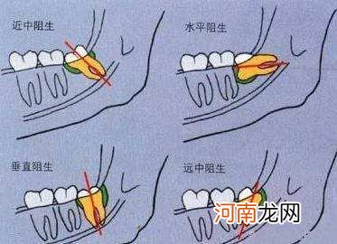 拔智齿哪里好you选怎么样 拔智齿哪里好