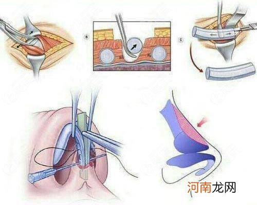 哪个医院做鼻子整形好 鼻整形哪里好