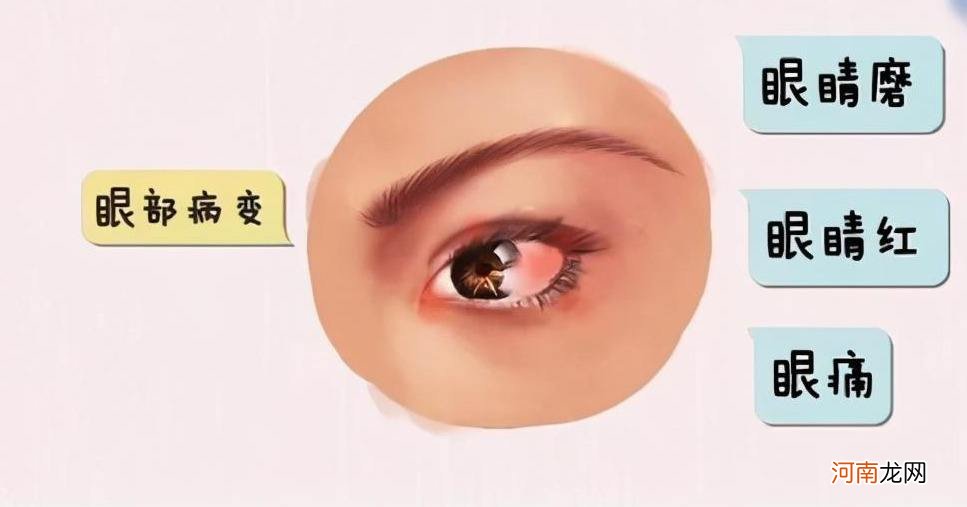 右眼肿胀眼皮一直跳怎么办 右眼肿胀眼皮一直跳