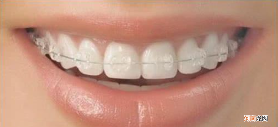 牙套3种类型简单介绍 矫正牙齿的牙套种类