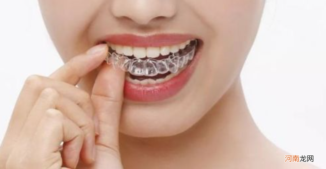 牙套3种类型简单介绍 矫正牙齿的牙套种类