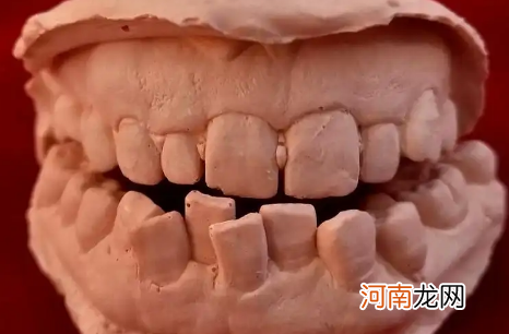 牙烂到什么程度要根管治疗