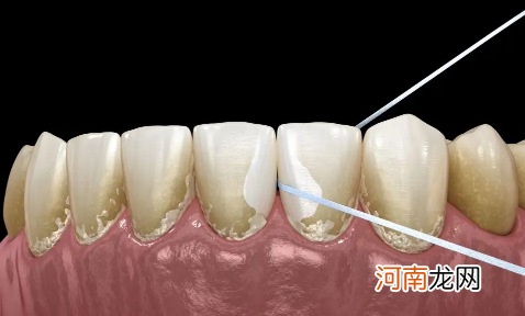 抠牙结石工具叫什么