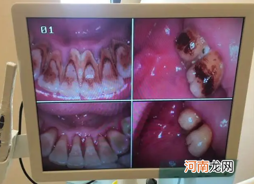 牙结石0度到3度的图