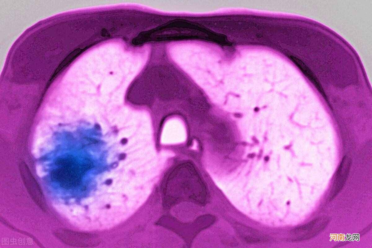 肺癌患者饮食怎么吃 肺癌饮食