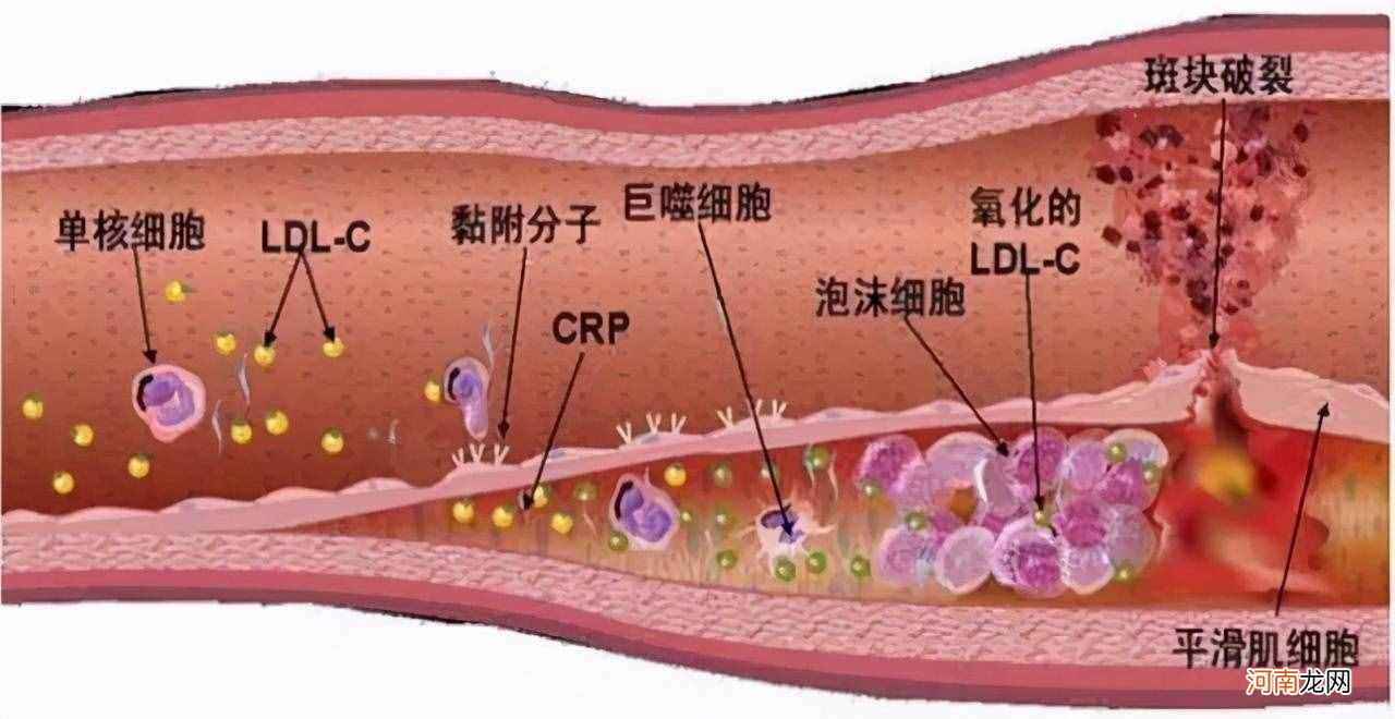 冠心病是由什么原因引起来的? 冠心病原因?
