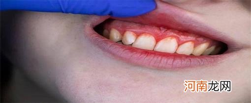 牙龈出血是什么状况