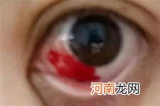 眼睛红红的像出血一样可能是结膜下出血