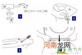 马桶盖螺丝怎么安装