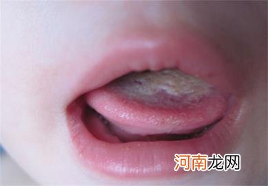 孩子鹅口疮怎么治疗