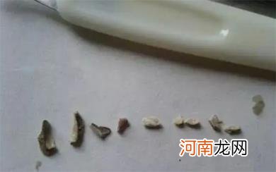 牙结石有必要去洗牙吗