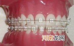 牙套有几种类型